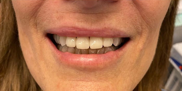 Antes y después de un tratamiento de férulas completas en Dental System